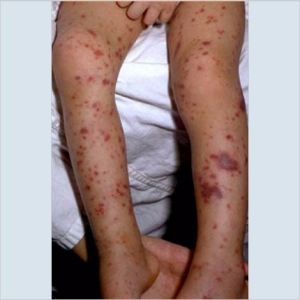 lower extremities of a child with the non-blanching petechial or purpuric rash caused by meningococcemia