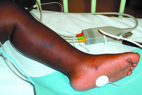 marked purpura in the left foot of an adolescent